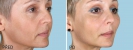 Vytažení-střední-etáže-obličeje-tváře-endotinem-5.jpg